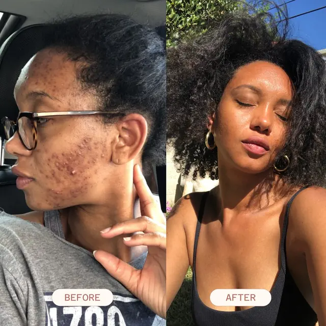 Clear Skin Essentials Kit