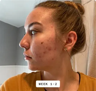 Skin progress