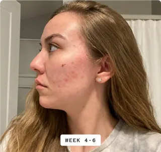 Skin progress